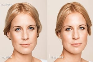 Faltenbehandlung-Hyaluronsäure-und-Botox